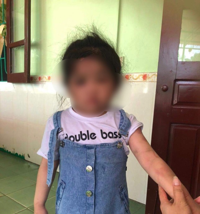Thông tin mới vụ dì ruột dùng chổi sắt đánh bé gái 4 tuổi vì lười ăn - Ảnh 1.