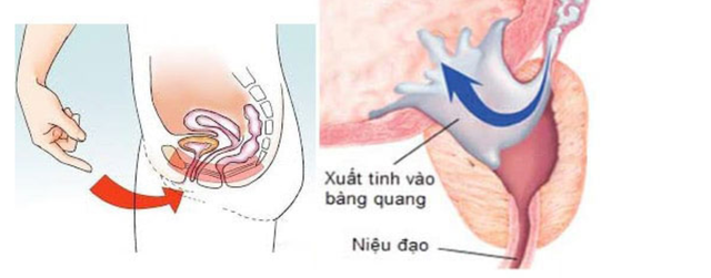 Nguyên nhân không ngờ khiến chàng trai trẻ mắc chứng mất tích tinh trùng, rối loạn cương dương - Ảnh 3.