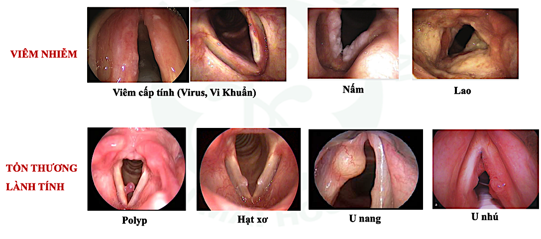 Bất ngờ thay đổi giọng nói coi chừng khối u ác tính thanh quản, u não - Ảnh 1.