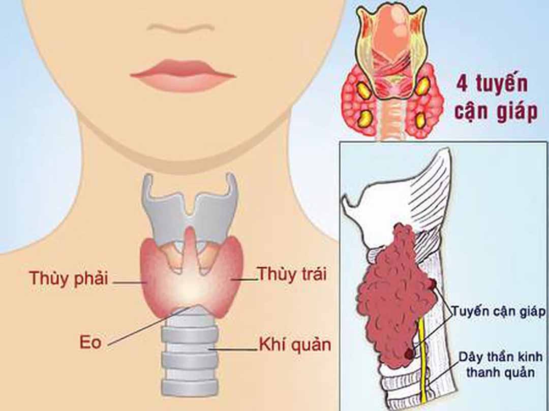 Cảnh giác với loại u thường gặp ở phụ nữ, diễn tiến âm thầm thời gian dài, khi phát hiện thường đã muộn - Ảnh 1.