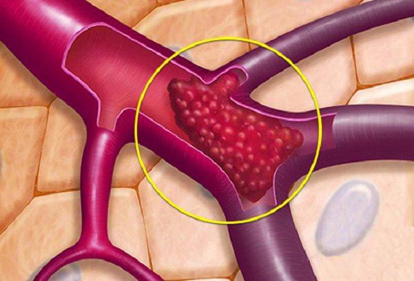 Những thực phẩm ‘dọn rác’ cho mạch máu, ăn thường xuyên có thể ngừa đột quỵ - Ảnh 2.