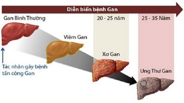 Vàng da, mệt mỏi, chán ăn… Cẩn thận với xơ gan do rượu - Ảnh 1.