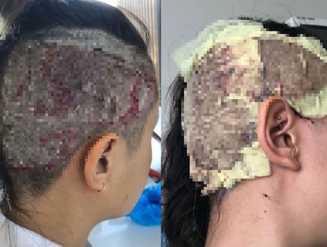Severely burned 75% of her face due to the explosion of the oil pan, 2 years later, the young girl confidently showed off a surprising new look - Photo 3.