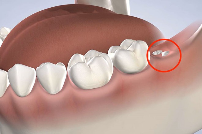 Vì sao luôn mọc ở chỗ không ai muốn, gây đau đớn nhưng răng khôn lại được đặt cái tên “thông minh” như vậy? Đáp án thật ra rất hợp lý - Ảnh 5.