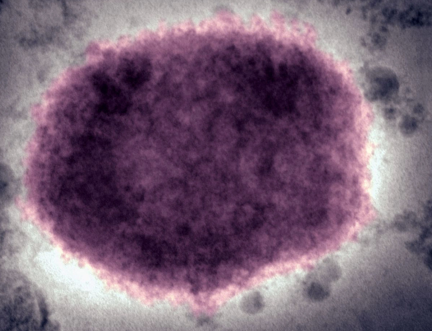 Bệnh đậu mùa khỉ: Virus gây bệnh nguy hiểm như thế nào? - Ảnh 1.