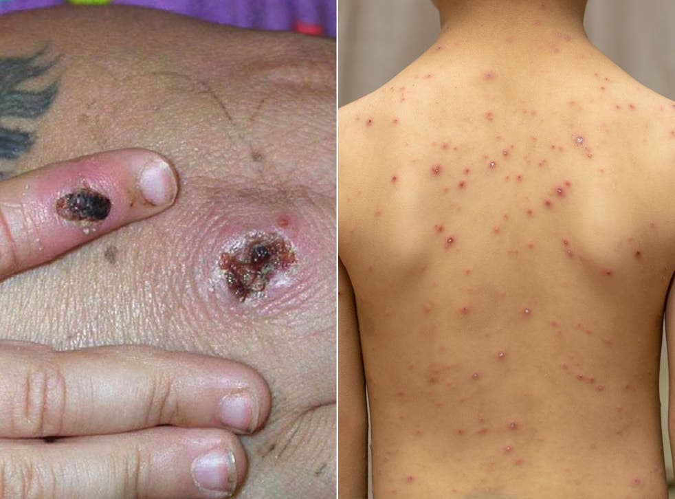 Bệnh đậu mùa khỉ bùng phát tại nhiều quốc gia: Nhóm chuyên gia chỉ ra điều bất thường - Ảnh 2.