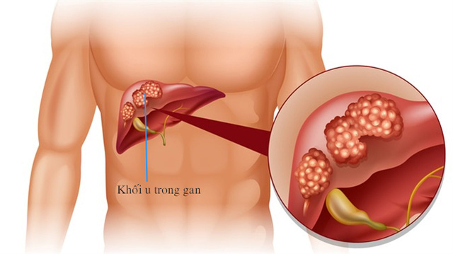 Diễn biến của bệnh ung thư gan và tiên lượng - Ảnh 1.