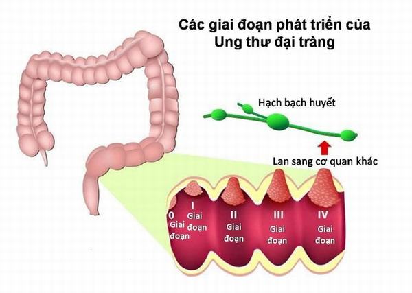 Ung thư đại trực tràng ngày càng trẻ hóa, dưới đây là yếu tố nguy cơ khiến nhiều người mắc phải căn bệnh này - Ảnh 1.