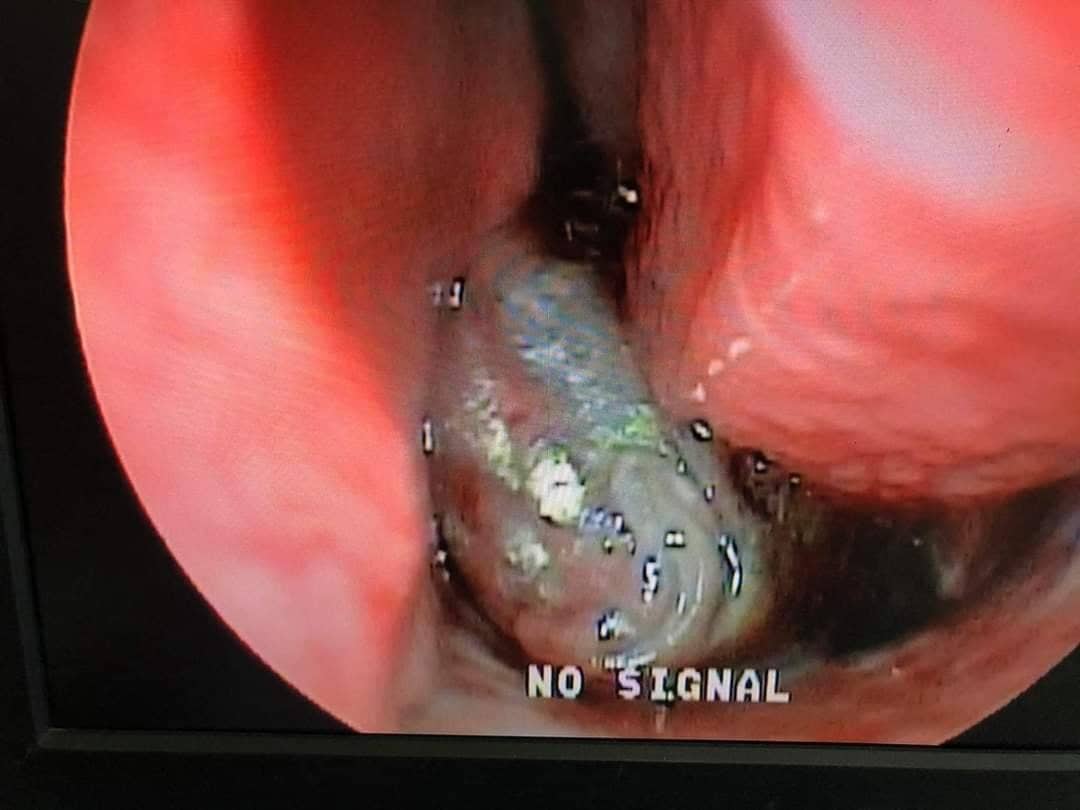 Viên bi trong mũi, cánh gà ngang thực quản: Những ca mắc dị vật khiến bác sĩ thót tim - Ảnh 2. Viên bi trong mũi, cánh gà ngang thực quản: Những ca mắc dị vật khiến bác sĩ thót tim - Ảnh 2.