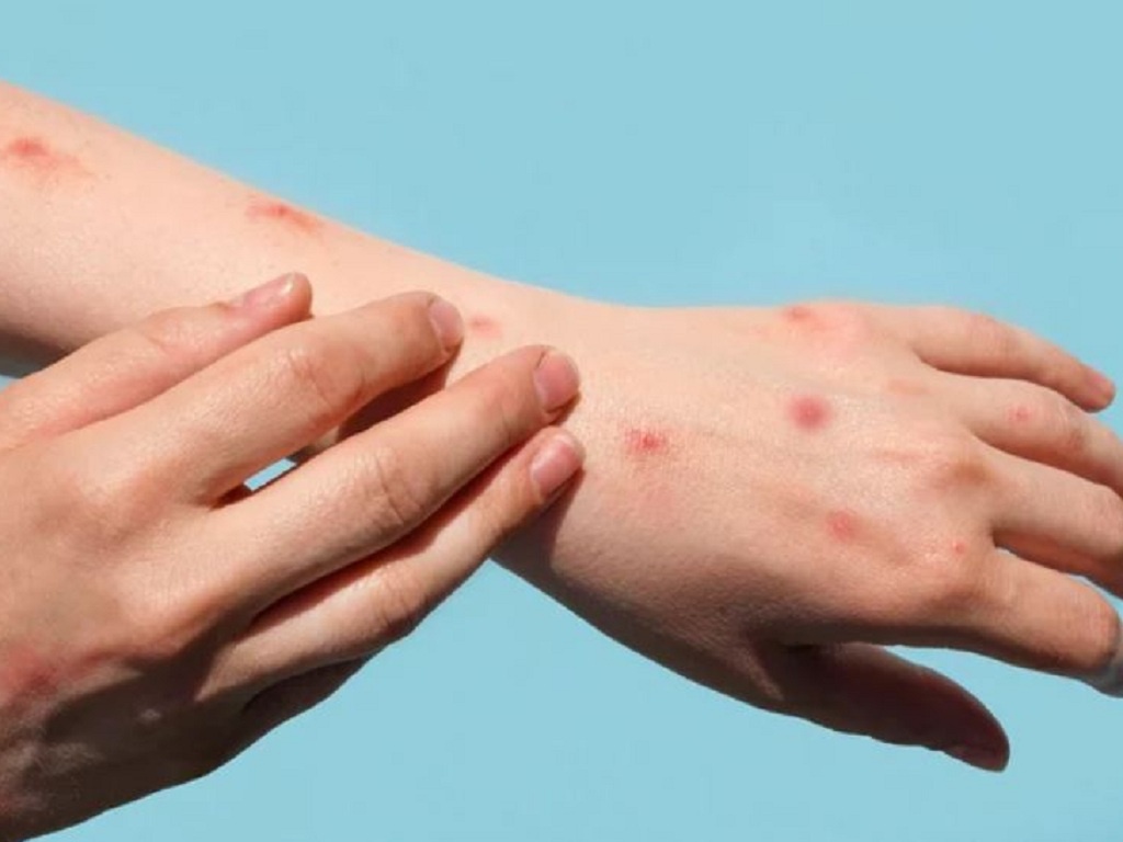 Đậu mùa khỉ đã xuất hiện ở Đông Nam Á: Tại sao cần cảnh giác? - Ảnh 3. Đậu mùa khỉ đã xuất hiện ở Đông Nam Á: Tại sao cần cảnh giác? - Ảnh 3.