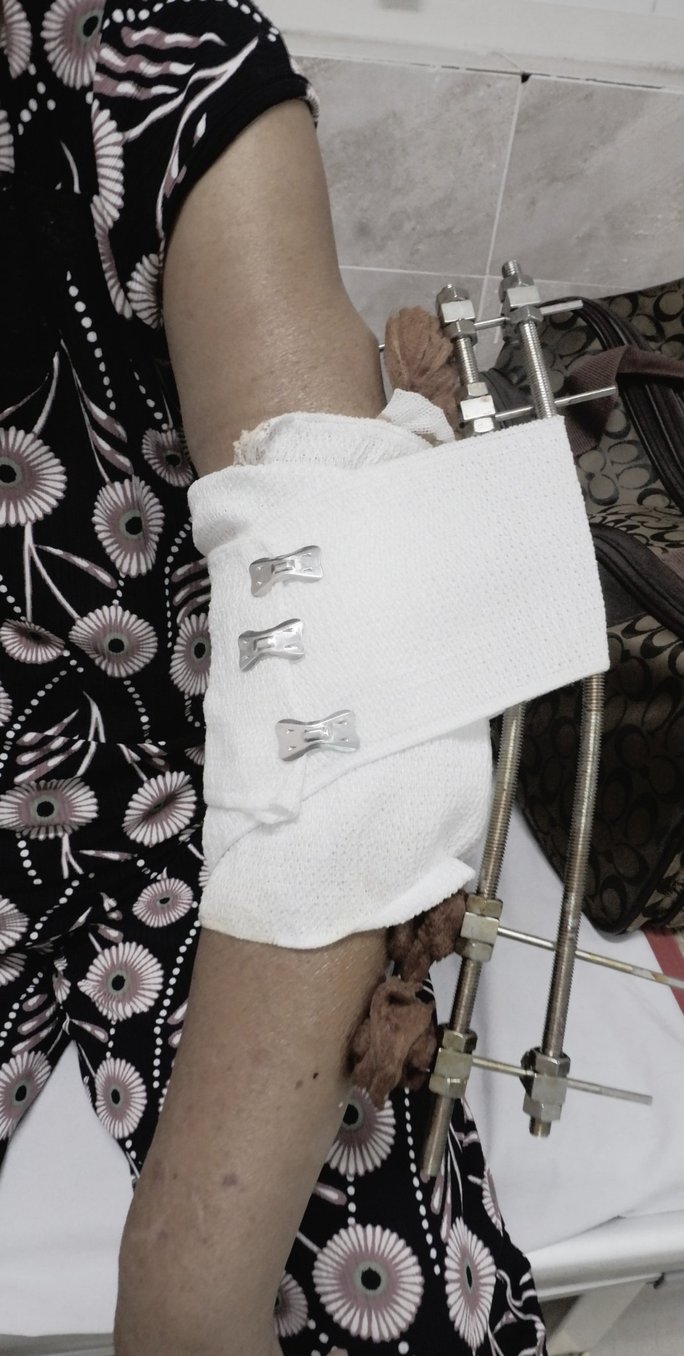 Nhiễm trùng nặng, hủy xương tay vì bó thuốc lá trị viêm khớp - Ảnh 1. Nhiễm trùng nặng, hủy xương tay vì bó thuốc lá trị viêm khớp - Ảnh 1.