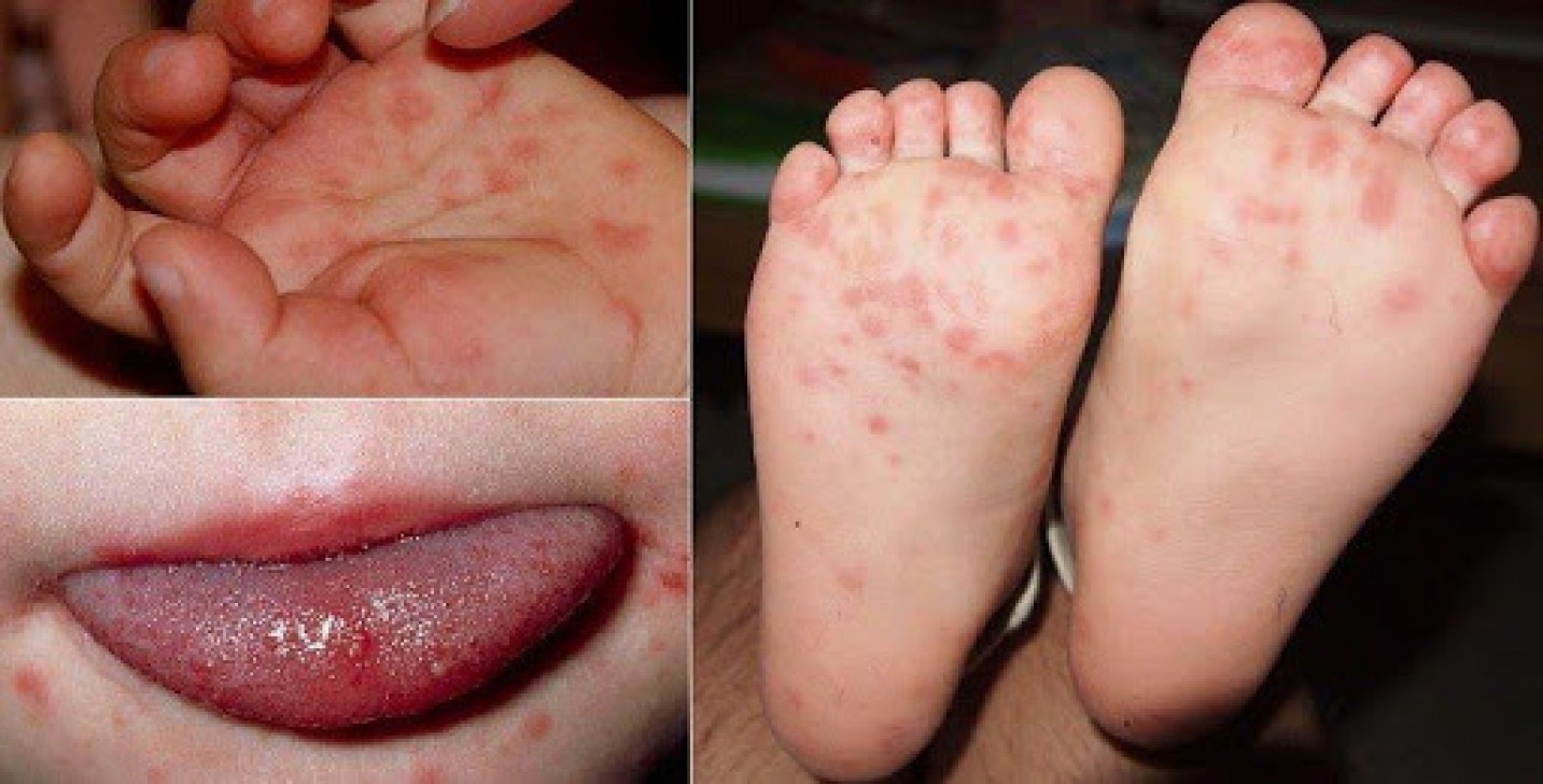 Hà Nội: Số ca tay chân miệng tăng gấp 4, đặc biệt chú ý 3 dấu hiệu này - Ảnh 1.