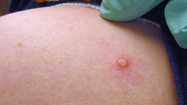 Warning monkey smallpox virus may have spread silently - Photo 1.
