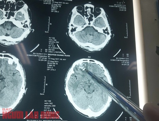 Vụ người dân tố bị đánh chấn thương sọ não: Có kết quả giám định ghi âm - Ảnh 1.