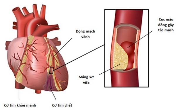 5 nguyên nhân phổ biến khiến quý ông dễ bị bất lực - Ảnh 2.