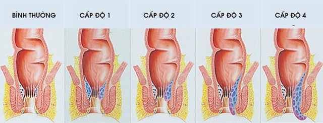 Cách phòng tránh bệnh trĩ ở nam giới tuổi trung niên - Ảnh 1.