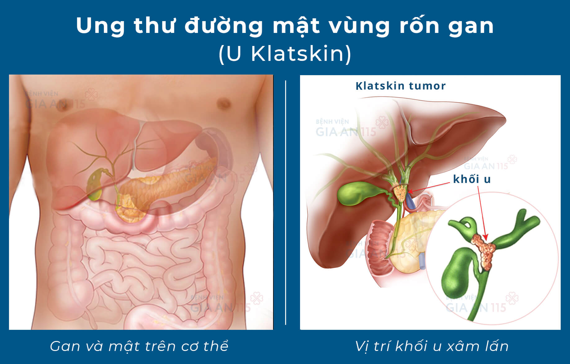 34 tuổi đã mắc căn bệnh ung thư thường chỉ gặp ở người trên 60: 3 triệu chứng cần lưu ý - Ảnh 1.