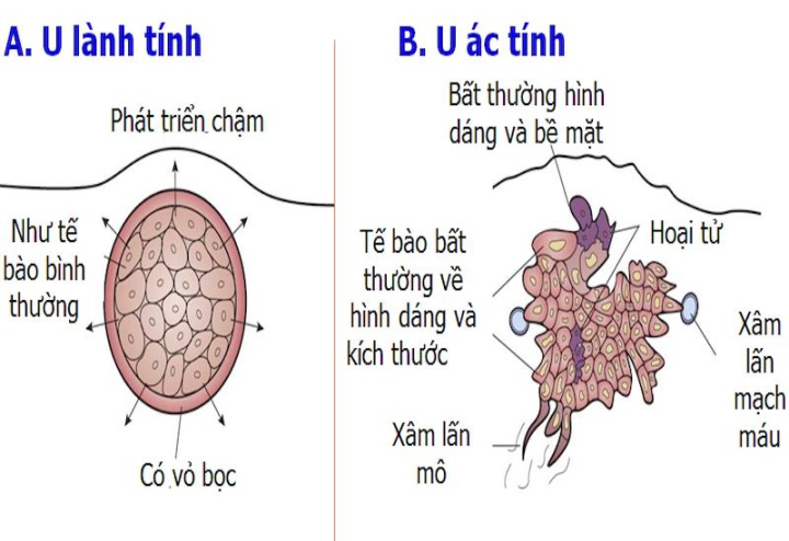 Thuộc lòng những biểu hiện của khối u ác tính này để đi khám ngay kẻo muộn - Ảnh 1.