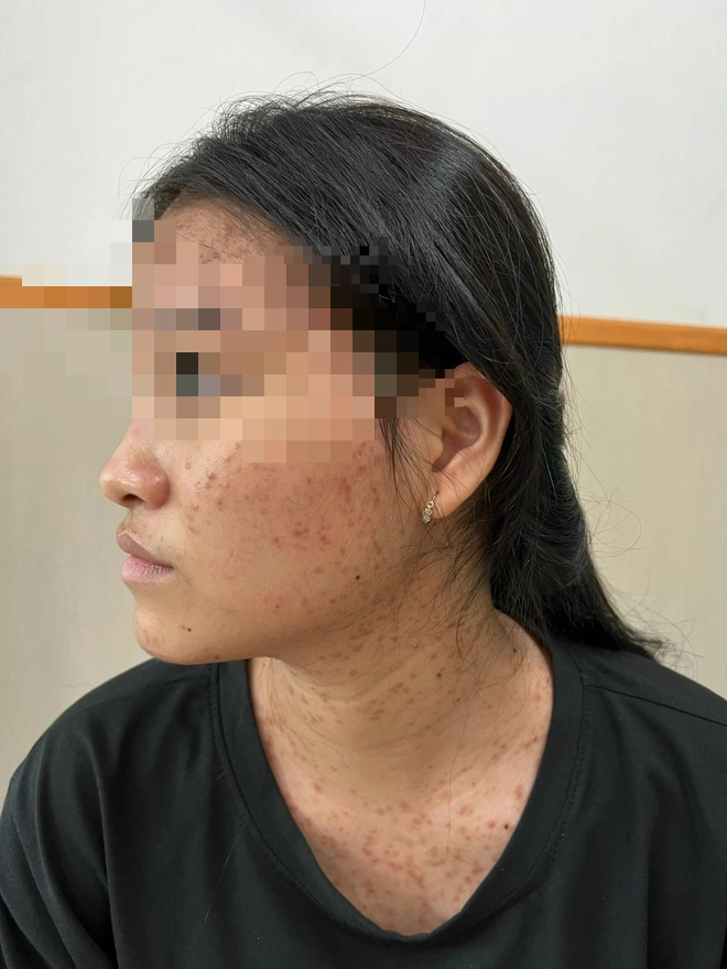 Chuyên gia chỉ ra 5 sai lầm thường gặp khiến mụn trứng cá ngày càng trầm trọng