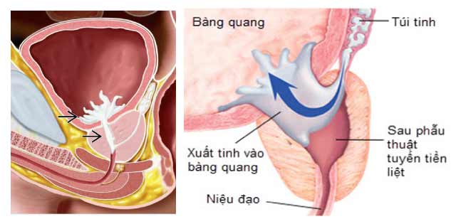 Xuất tinh ngược dòng, khi nào cần đến gặp bác sĩ? - Ảnh 1.