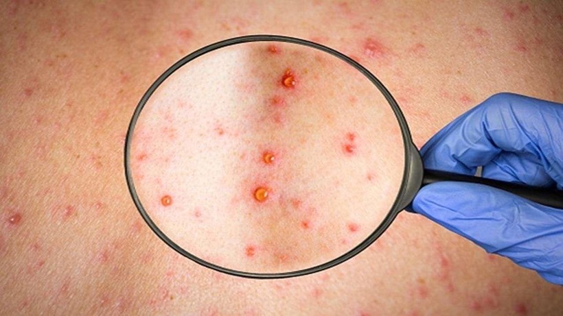 5 câu hỏi thường gặp về bệnh đậu mùa khỉ - Ảnh 1.