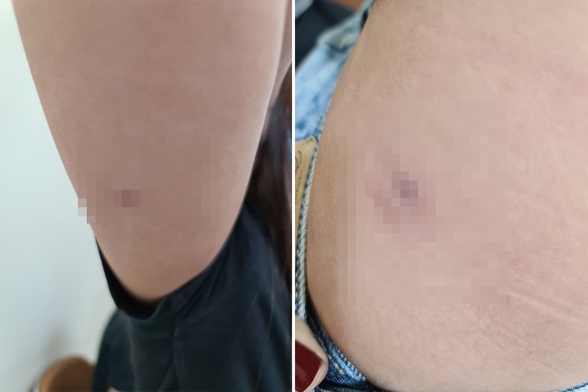 Tiêm thuốc giảm mỡ bụng, cô gái bị sưng mủ, chảy dịch, viêm nhiễm - Ảnh 1. Tiêm thuốc giảm mỡ bụng, cô gái bị sưng mủ, chảy dịch, viêm nhiễm - Ảnh 1.