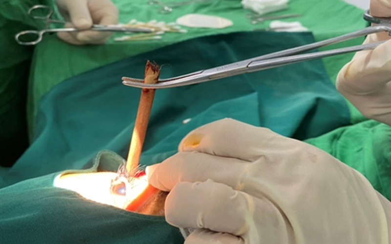 Cứu bệnh nhân nhập viện với cây đũa tre cắm sâu vào hốc mắt - Ảnh 1. Cứu bệnh nhân nhập viện với cây đũa tre cắm sâu vào hốc mắt - Ảnh 1.