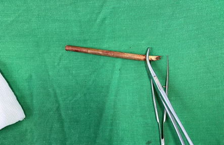 Cứu bệnh nhân nhập viện với cây đũa tre cắm sâu vào hốc mắt - Ảnh 4.