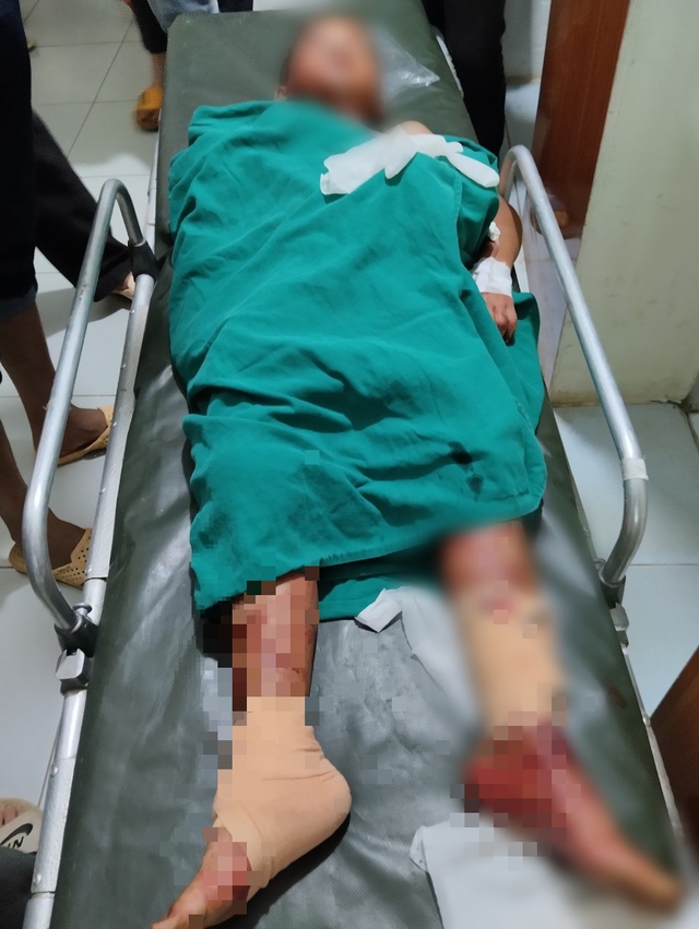 Vụ nổ bom bi ở Sơn La: 2 cháu bé đã được các y bác sĩ cứu sống một cách kỳ tích - Ảnh 2.