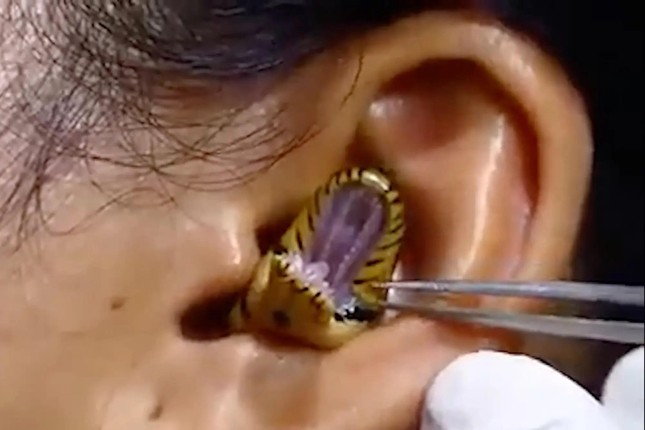 Nghi vấn clip rắn nằm trong tai người gây xôn xao ở Ấn Độ - Ảnh 1.