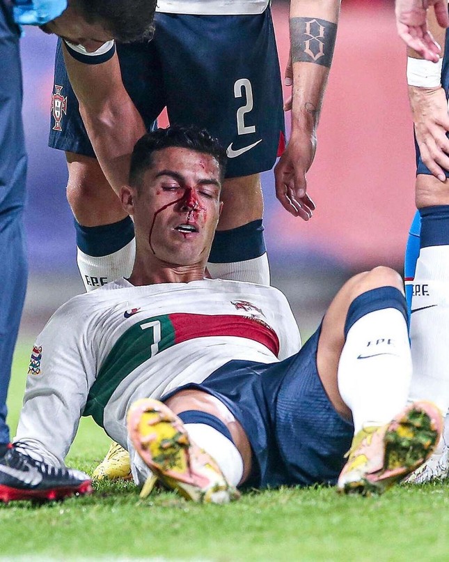 Ronaldo bê bết máu vì bị thủ môn đối phương đấm gãy mũi - Ảnh 1.