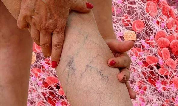 Người phụ nữ mất 2 chân vì cục máu đông: Cảnh giác với những dấu hiệu đầu tiên của bệnh - Ảnh 1.