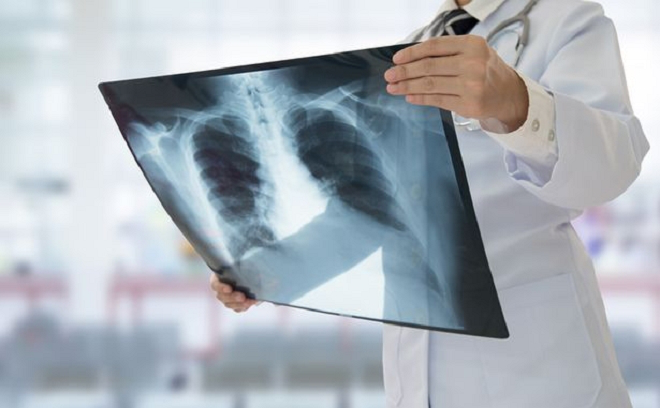 Cảnh báo: Dấu hiệu bệnh ung thư phổi  thường thấy ở vai và cánh tay - Ảnh 2.