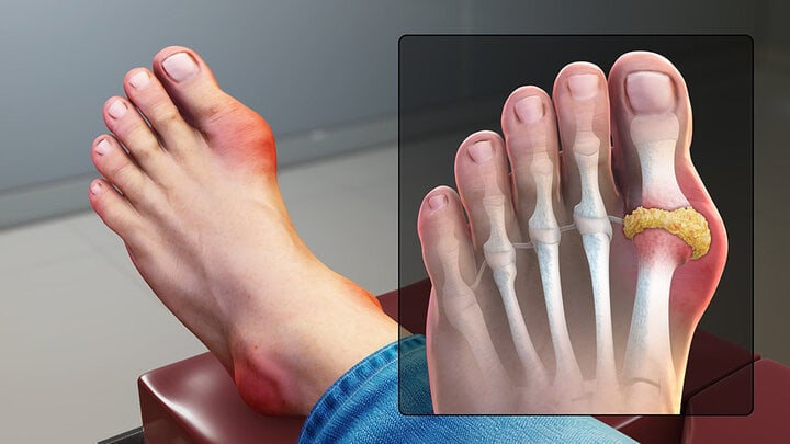 Bệnh gout có xu hướng trẻ hóa, bác sĩ chỉ cách phòng ngừa - Ảnh 1.