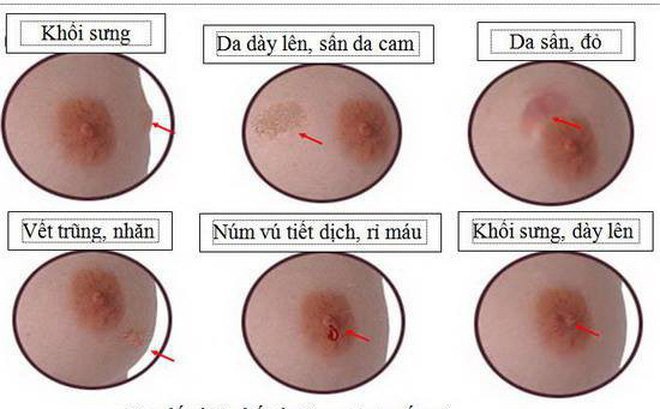 8 dấu hiệu cảnh báo khả năng có khối u đang phát triển trong ngực - Ảnh 3.