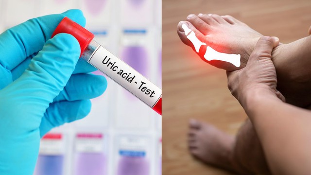 10 cách đào thải acid uric một cách tự nhiên, ngừa gout hiệu quả: Nhiều người chưa biết để làm - Ảnh 1.