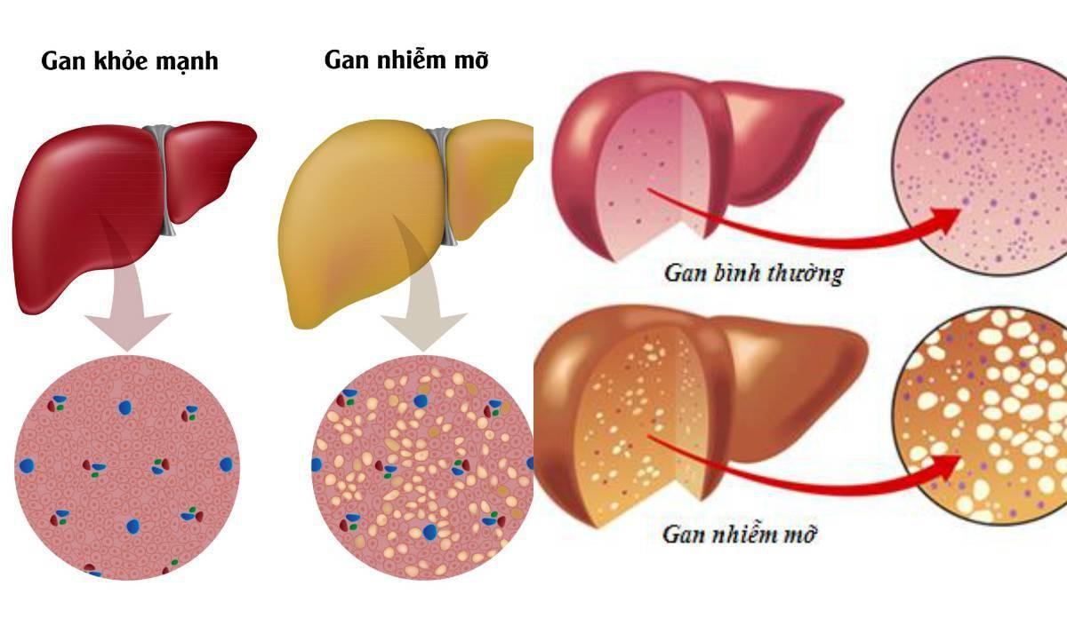 Cô gái 25 tuổi bị gan nhiễm mỡ nặng sau khi giảm cân trong 6 tháng - Ảnh 2.