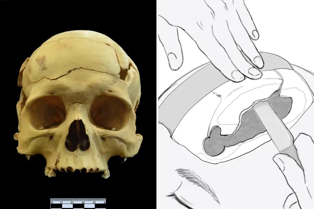 Phát hiện ca phẫu thuật kỳ lạ cách đây 2.700 năm, Hoa Đà đòi “mổ sọ” cho Tào Tháo hóa ra là có thật? - Ảnh 6.