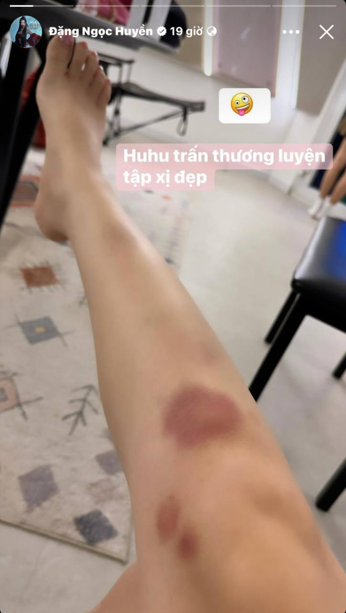 Các chị đẹp liên tiếp chấn thương: Hồng Nhung phải nhập viện, Lệ Quyên bật móng, mới nhất là Huyền Baby - Ảnh 3.