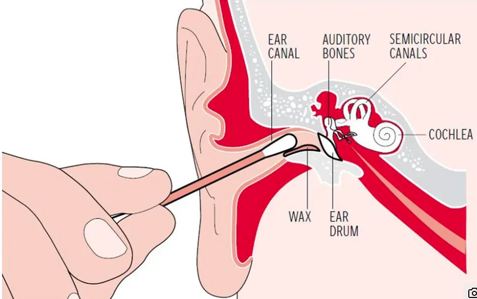 Phải làm gì khi bị ngứa tai? - Ảnh 1.