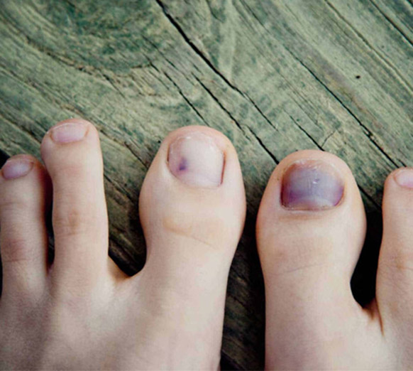 5 điều khác lạ ở chân có thể là tín hiệu cảnh báo mỡ máu cao