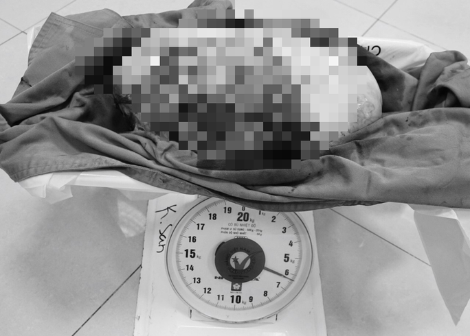 Bụng to rất nhanh trong vòng 5 tháng, đi khám mới biết có khối u 6,5 kg - Ảnh 2.