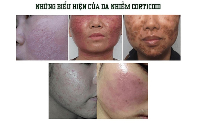  Một hoa hậu suýt hỏng da bởi sử dụng kem có corticoid - Ảnh 3.