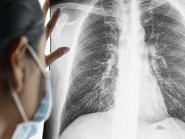 2 yếu tố tăng nguy cơ mắc ung thư phổi đang bủa vây người Việt: Phòng tránh thế nào? - Ảnh 1.