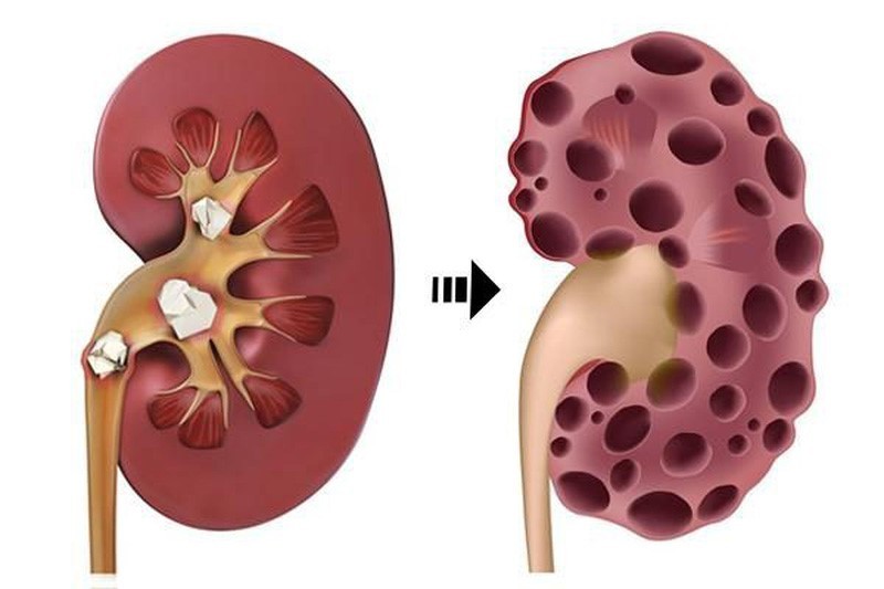 Những triệu chứng suy thận giai đoạn đầu cần chú ý - Ảnh 2.