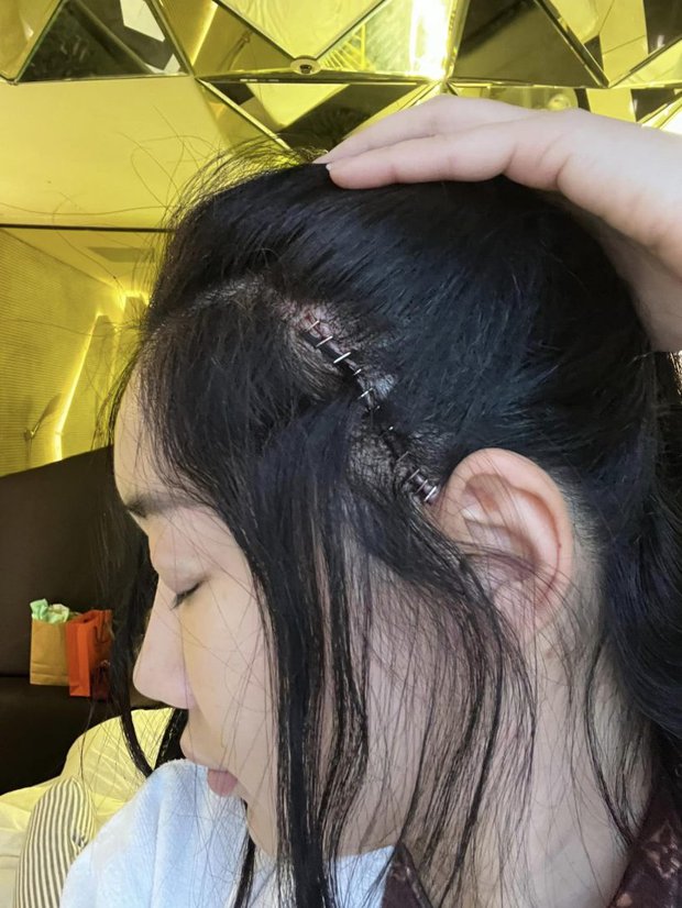 Hoa hậu Thái Lan đăng ảnh sẹo dài ở đầu sau phẫu thuật thẩm mỹ - Ảnh 2.