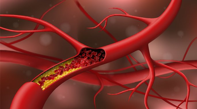 Cholesterol cao: Thêm nguyên nhân bất ngờ, không liên quan ăn uống - Ảnh 1.