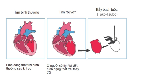 Căng thẳng kéo dài, người phụ nữ suýt chết vì trái tim tan vỡ - Ảnh 2.