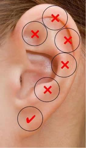 Nữ sinh 15 tuổi xỏ lỗ tai gây viêm màng sụn, biến dạng vành tai, chuyên gia cảnh báo - Ảnh 2.