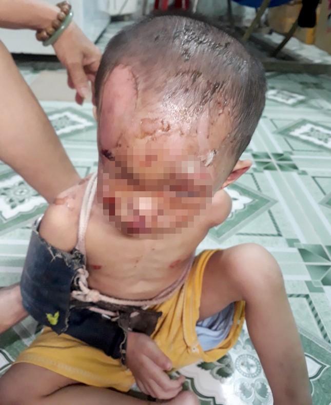 Nghi vấn bé trai ở TPHCM bị cha mẹ đánh đập dã man, trên người đầy vết thương - Ảnh 2.